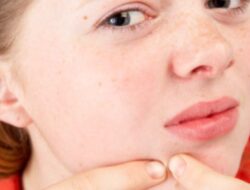 Jangan Sampai Salah! Ini Cara Mengatasi Closed Comedo yang Benar