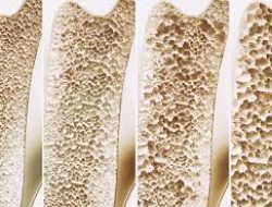 Perosi Catat 41,7 Persen Warga Kena Osteopenia, Ini Kunci Mencegah Osteoporosis Sejak Dini